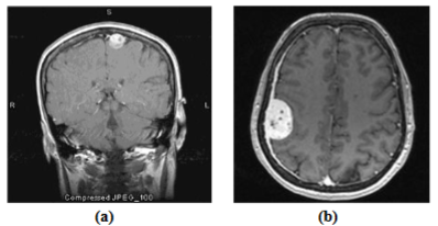 (a)Meningioma-mild case (b)Meningioma-advance case.